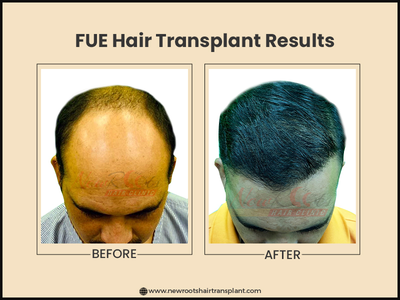 How effective is FUE hair transplant in India