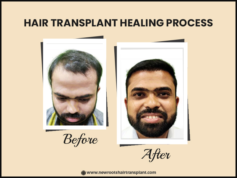 Hair Transplant Healing Process in india