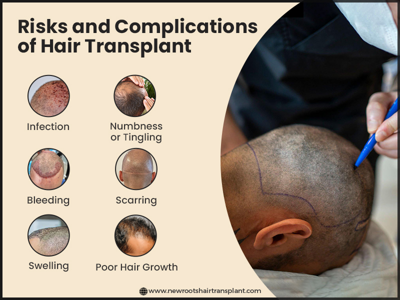 Risks and Complications of Hair Transplant