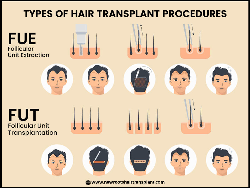 Types of Hair Transplant Procedures