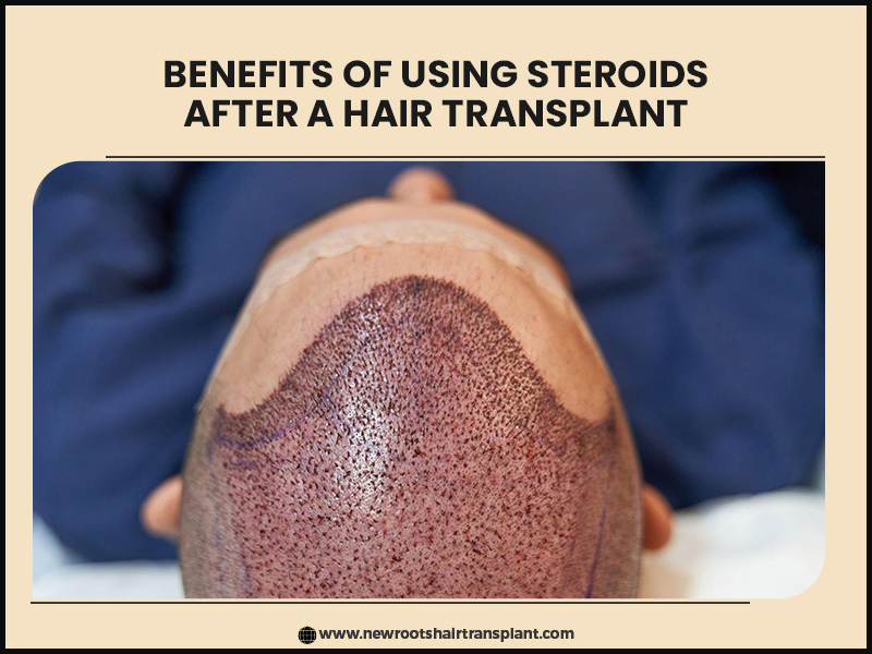 benefits of using steroids after a hair transplant