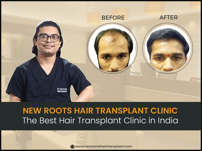 Hair Transplant Cost in India: Get the Best Price for 2023