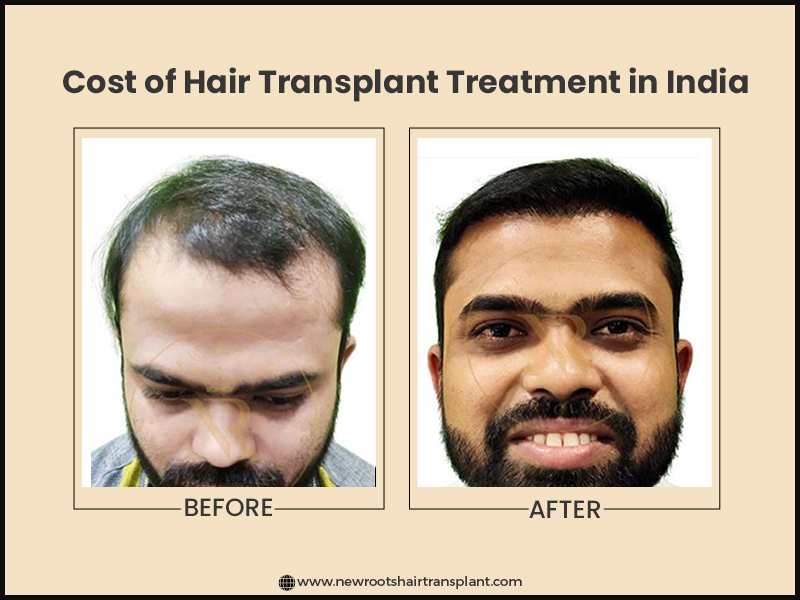 Hair Transplant Cost in India Get the Best Price for 2023