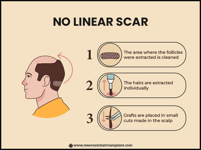 fue hair transplant in india