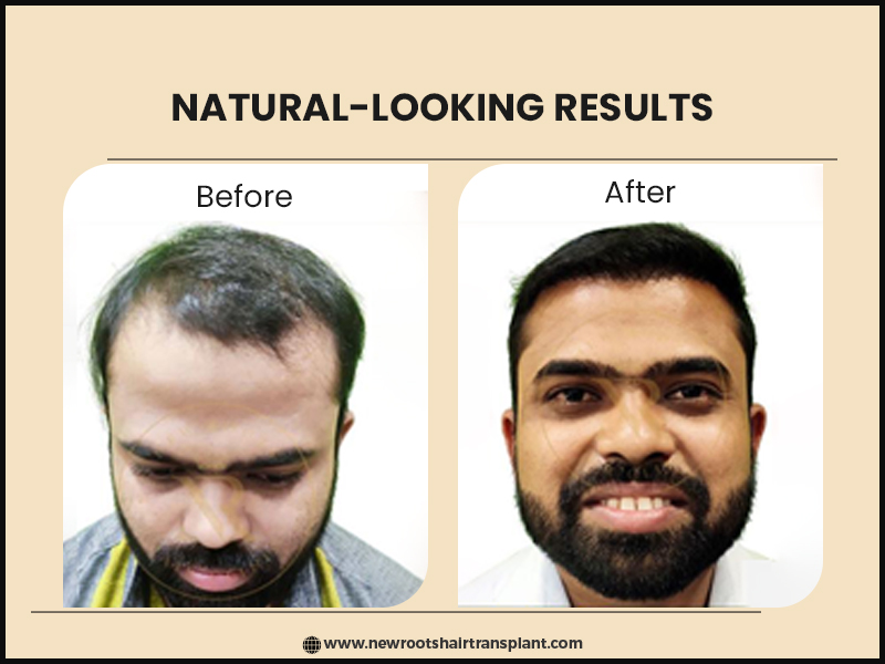 fue hair transplant results