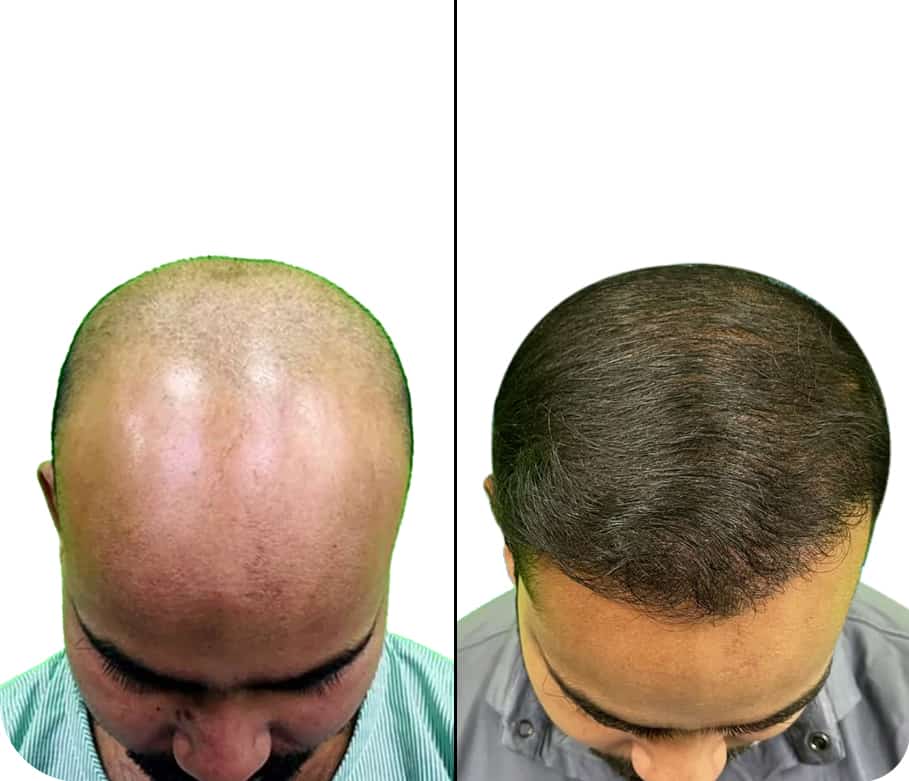 Best Hair Transplant In Kolkata Fue Hair Transplant